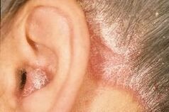 Sinais de helmintos no corpo