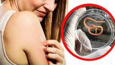 Uma erupção cutânea no corpo é um sinal de infecção por helmintos